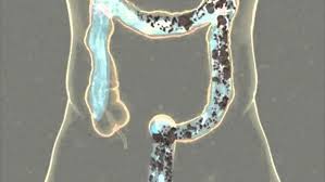 hidroterapia de colon